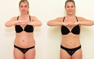 Lipotransfer