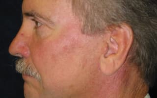 Rhinoplastik