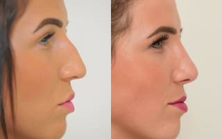 Rhinoplastik