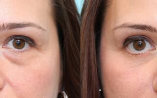 Augenringe und Tränensack