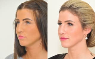 Rhinoplastik