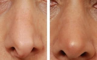 Rhinoplastik