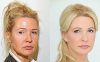 Facelift