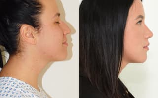 Rhinoplastik