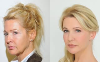 Facelift