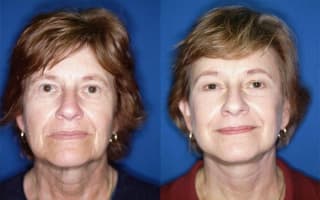 Facelift