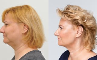 Fettabsaugung aus dem Doppelkinn