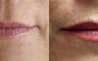 Botulinumtoxin