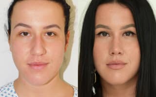 Rhinoplastik