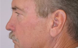 Rhinoplastik