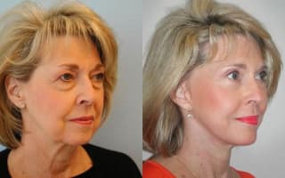 Facelift