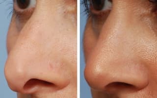 Rhinoplastik