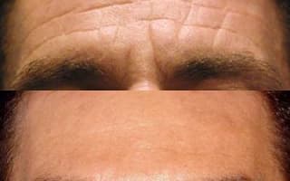 Botulinumtoxin