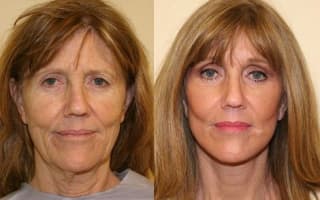 Facelift