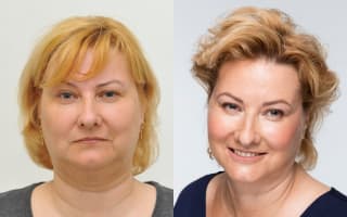 Fettabsaugung aus dem Doppelkinn