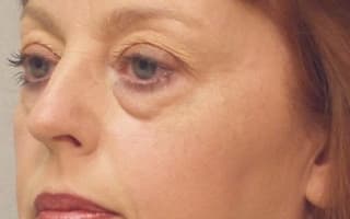 Augenringe und Tränensack