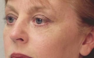 Augenringe und Tränensack