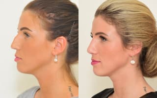 Rhinoplastik