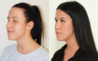 Rhinoplastik