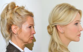 Facelift