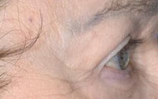 Augenringe und Tränensack