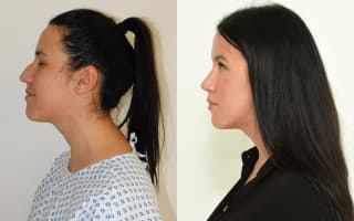 Rhinoplastik