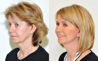 Facelift
