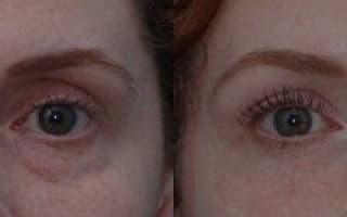Augenringe und Tränensack