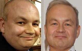 Fettabsaugung aus dem Doppelkinn