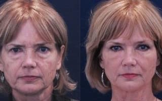 Augenringe und Tränensack