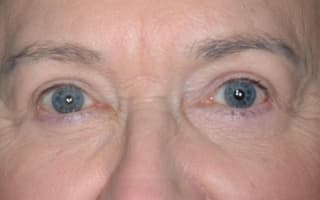 Augenringe und Tränensack