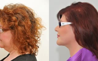 Fettabsaugung aus dem Doppelkinn