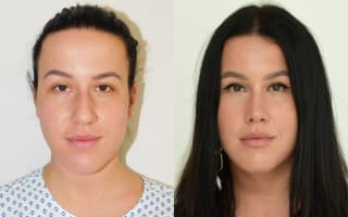 Rhinoplastik