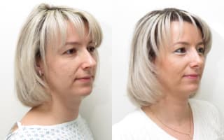Rhinoplastik