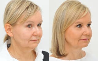 Fettabsaugung aus dem Doppelkinn