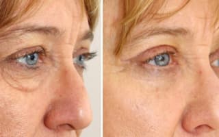 Augenringe und Tränensack