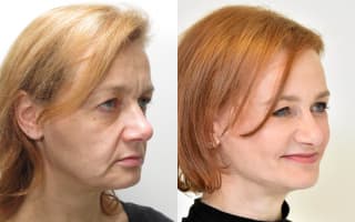 Facelift