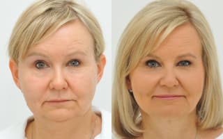 Fettabsaugung aus dem Doppelkinn