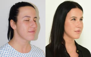 Rhinoplastik