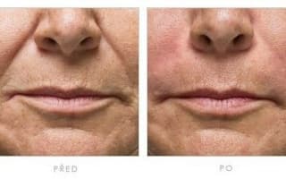 Botulinumtoxin