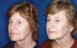 Facelift