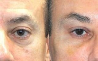 Augenringe und Tränensack