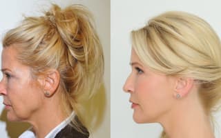 Facelift