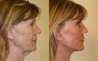 Facelift