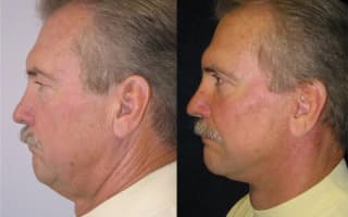 Facelift