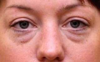 Augenringe und Tränensack