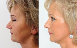 Facelift