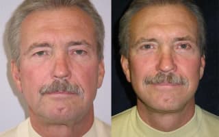Facelift