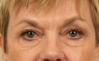 Augenringe und Tränensack