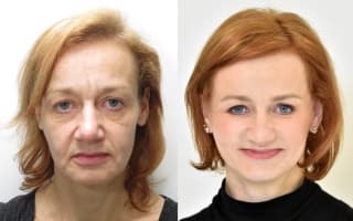 Facelift